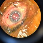 پیوند قرنیه در بیمارستان دکتر بسکی